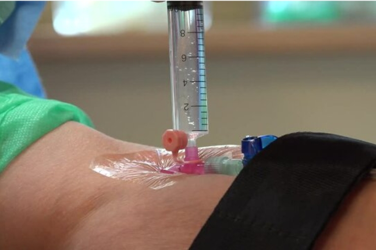 CAPD Catheter Insertion------23