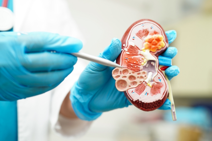 Kidney Disease Treatment------23